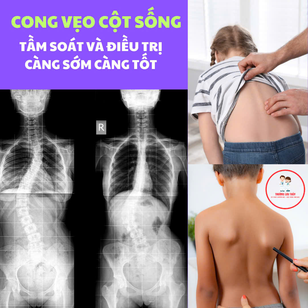 Chẩn đoán và điều trị cong vẹo cột sống