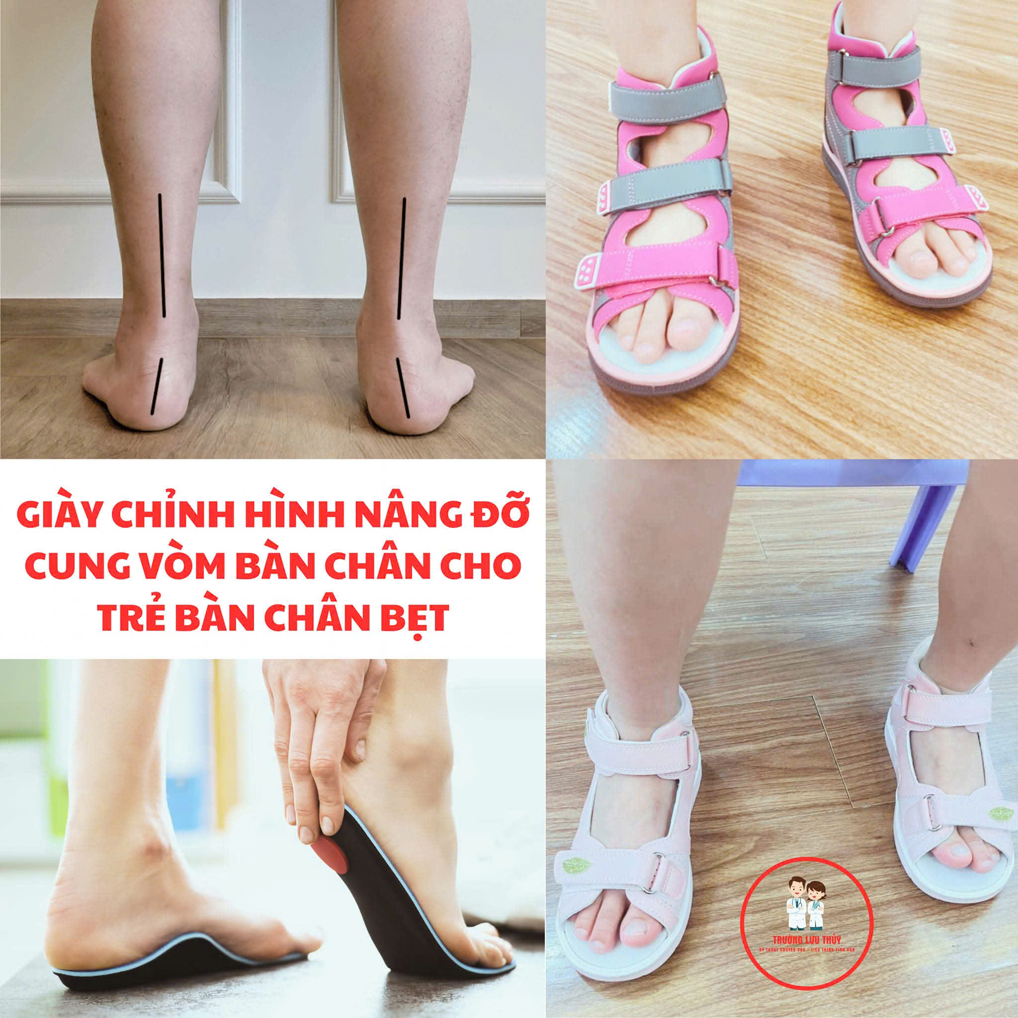 Bàn chân bẹt và phương pháp điều trị